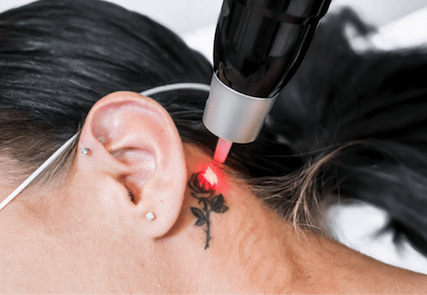 Tattoo Removal: An unexplored domain for PRP Therapy