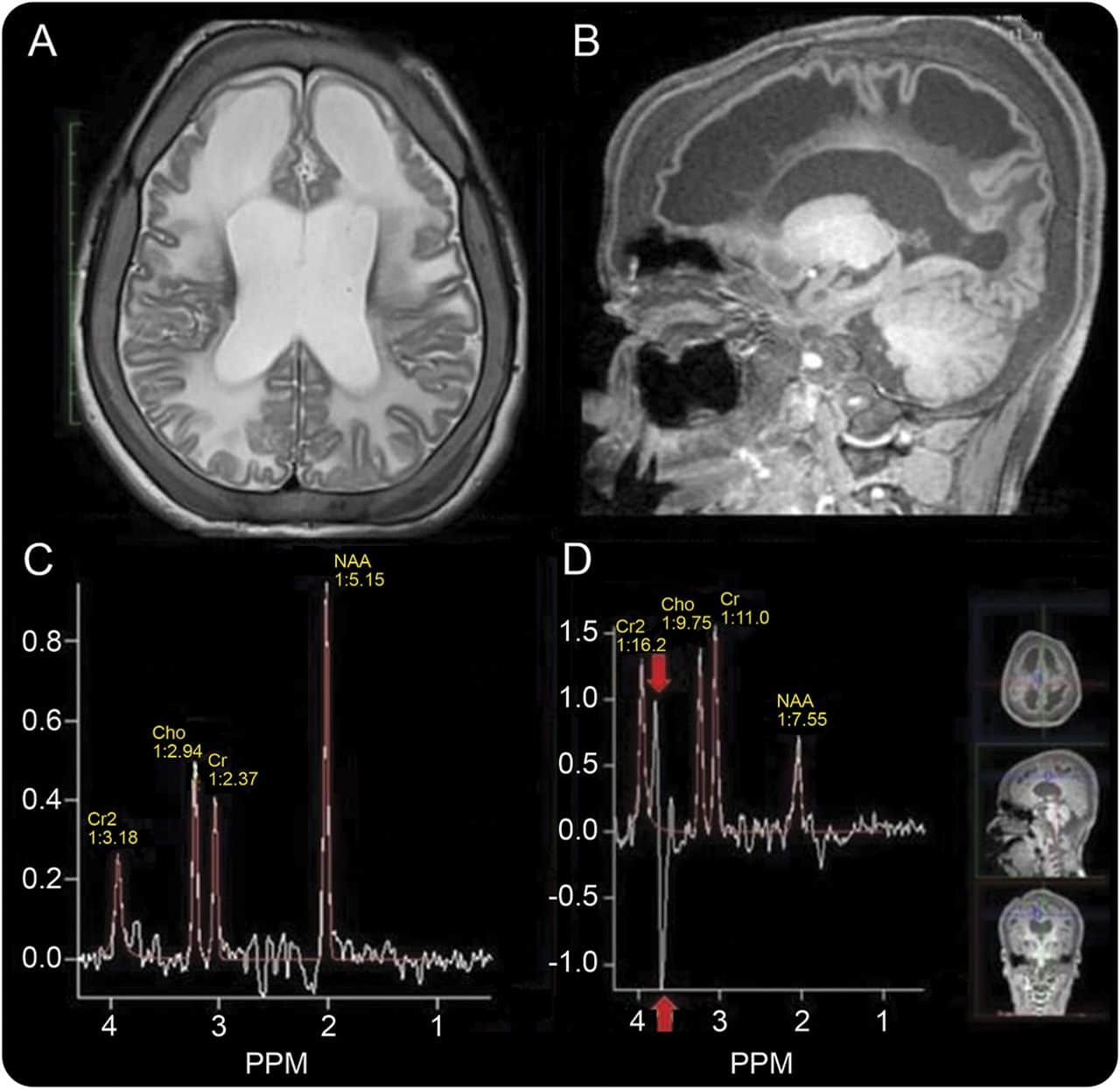 Decoding the World’s Rarest Disease: RPI Deficiency
